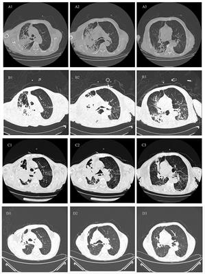 Streptomyces albireticuli lung infection managed as a pulmonary air cyst: a case report and literature review